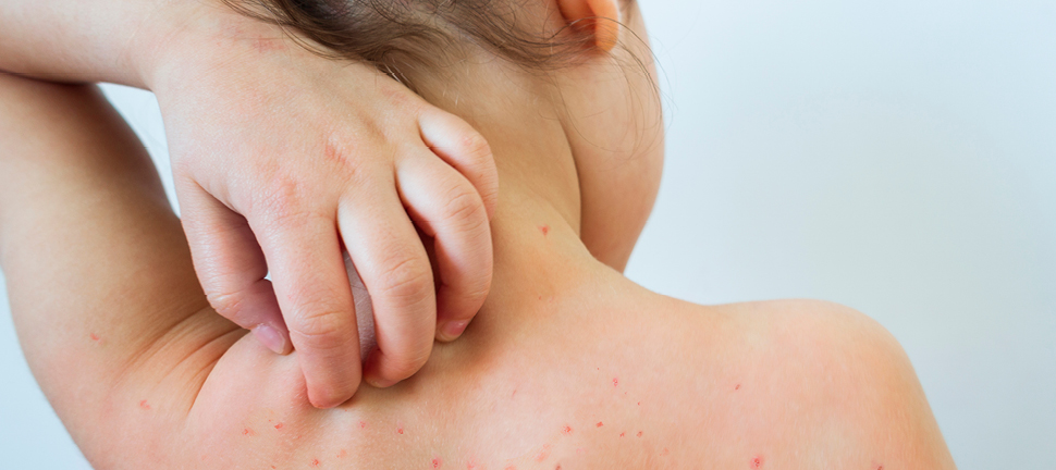 Is my child’s rash serious? - Mediclinic